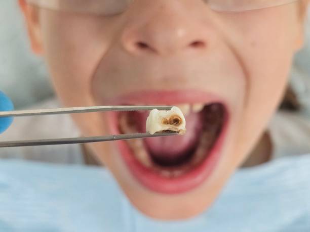 Best Broken or Chipped Tooth Repair in Forks, WA